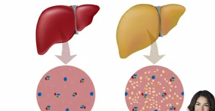 Come trattare il fegato grasso in modo naturale
